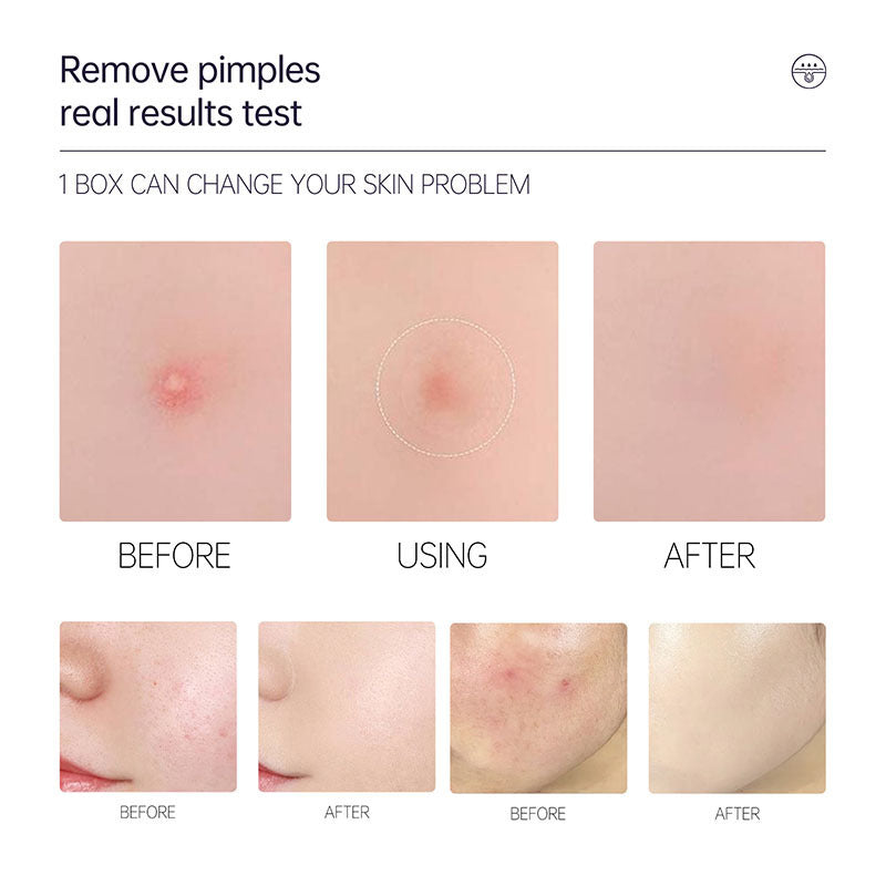 Patch Invisible Acne Patch Concealer